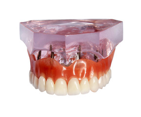 Model of a jaw and denture 1 © ann0306