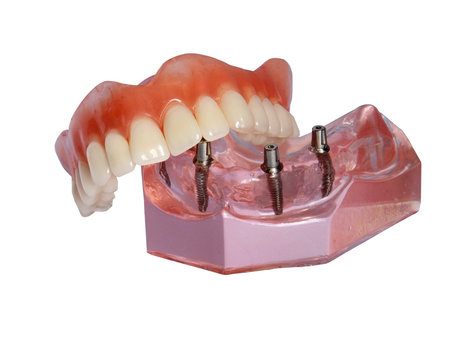 Model of a jaw and denture 2