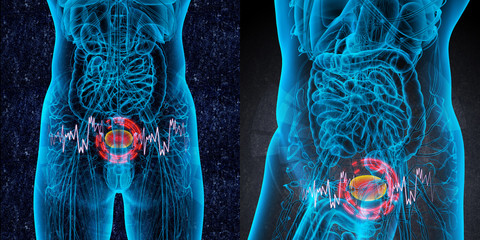 3D rendering medical illustration of the bladder pain - obrazy, fototapety, plakaty