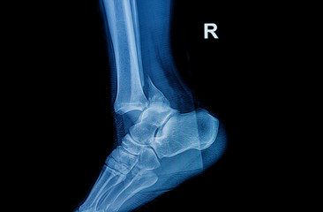 Fracture ankle fibula bone ( leg bone ) X-ray of leg side and view