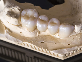 Monolithic zirconia restorations  implant supported with the ceramic load in vestibular, back background