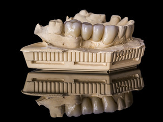 Monolithic zirconia restorations  implant supported with the ceramic load in vestibular, back background