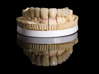 Monolithic zirconia restorations  implant supported with the ceramic load in vestibular, back background