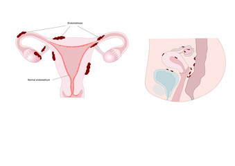 endometriosis: main locations of abnormal tissue growth