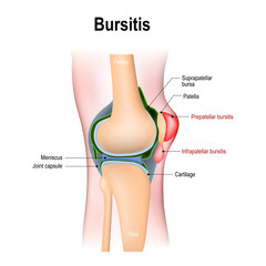 Bursitis is the inflammation of bursae