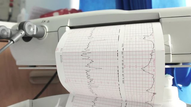 Heart beat monitor ECG readout with heart graph. Filmed on a hospital bed in closed ward