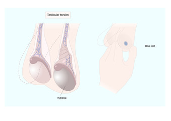 testicular torsion (torsion of the spermatic cord) can induce ischemia of the testicle - obrazy, fototapety, plakaty