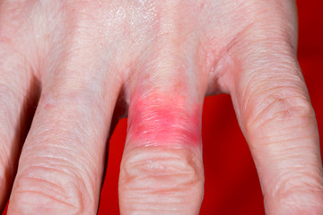 A woman has reddened skin and a strong itching
