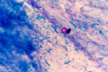 stool specimen shows Cryptosporidium eggs in red.