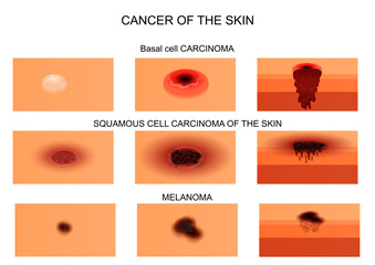 types of skin cancer.