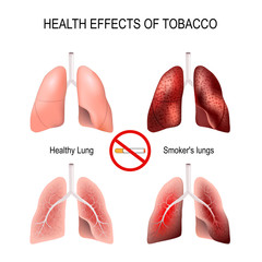Health effects of smoking