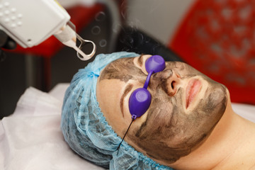 Carbon face peeling. Laser pulses clean the skin of the face. Hardware cosmetology. The process of photothermolysis, warming the skin. Facial skin rejuvenation.