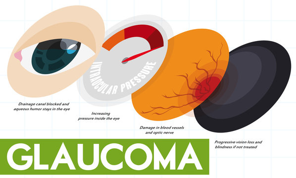 Descriptive Infographic Showing Some Stages Of Glaucoma Disease, Vector Illustration