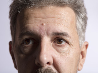The initial stage of eye disease