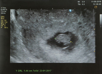 ultrasound of a fetus at 7 weeks 5 Days