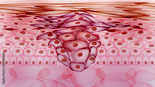 growing tumor cad file download