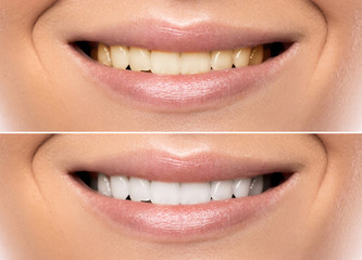 Comparison after teeth whitening
