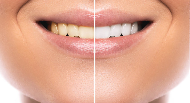 Comparison after teeth whitening