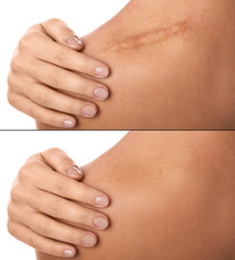 Result after procedure of scar removing - obrazy, fototapety, plakaty