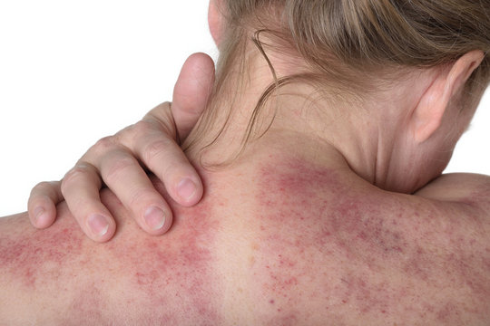 R&uuml;cken nach Gua sha Behandlung