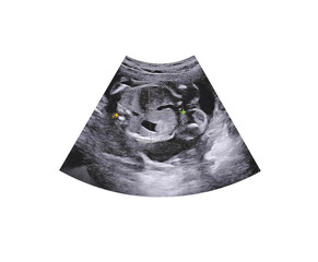 Ultrasound of baby in mother's womb.