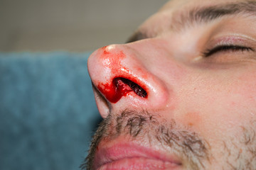 Broken nose close-up The man is bleeding from the nose.