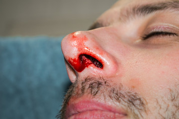 Broken nose close-up The man is bleeding from the nose.