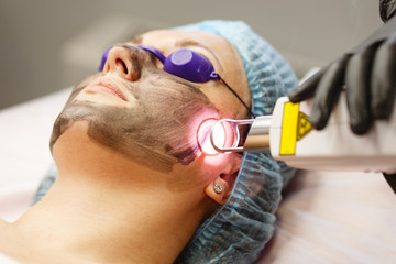 Carbon face peeling. Laser pulses clean the skin of the face. Hardware cosmetology. The process of...