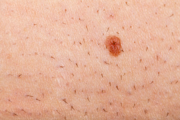 Nevus on a shaved human skin