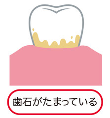 歯石　歯周病