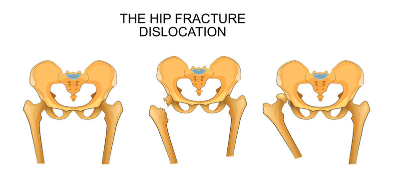 pelvis, hip fracture. hip dislocation