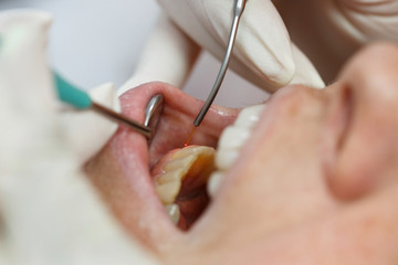 Dental laser used on a patient