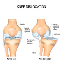 Knee dislocation and normal. - obrazy, fototapety, plakaty