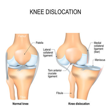 Knee Dislocation And Normal.