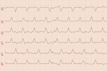 Arrhythmia electrocardiogram sheet