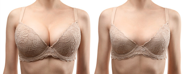 Woman before and after breast size correction on white background. Plastic surgery concept