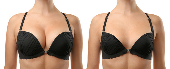 Woman before and after breast size correction on white background. Plastic surgery concept