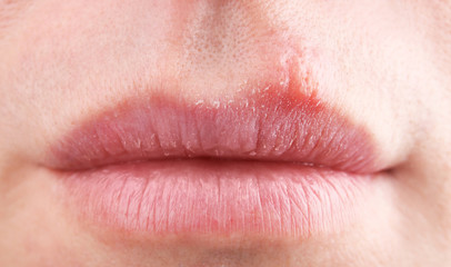 Herpes blisters on female lips closeup