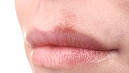 Herpes blisters on female lips closeup
