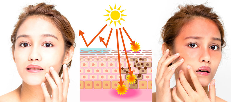 woman using sunscreen and woman getting sunburned