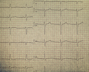 ECG on the plotting paper