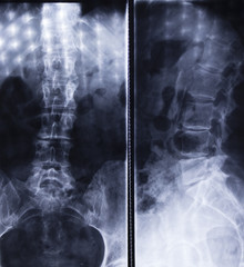 Xray of woman lower body