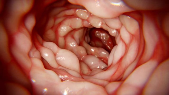 Darm, Morbus Crohn. 
Morbus Crohn ist eine chronisch-entzündliche Krankheit des Darms.
