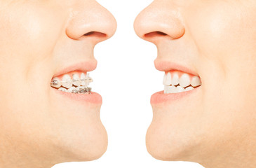 Before and after orthodontic treatment with braces