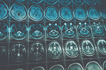 MRI or magnetic resonance image of head and brain scan, toned image