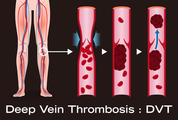 Economy class syndrome mechanism, deep vein thrombosis(DVT), Pulmonary Embolism(PE), coronary thrombosis, illustration diagram - obrazy, fototapety, plakaty