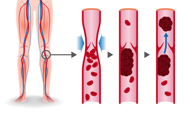 Economy class syndrome mechanism, deep vein thrombosis(DVT), Pulmonary Embolism(PE), coronary thrombosis, illustration diagram