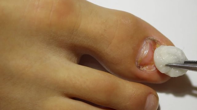 Medicated nail remedy. Sick nail. Fungal Nail treatment