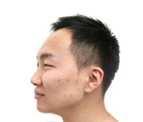 Young Asian man with problem skin on white background