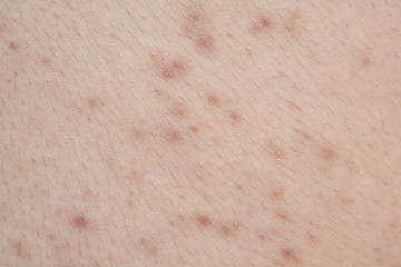 Fototapeta premium Acne on the back